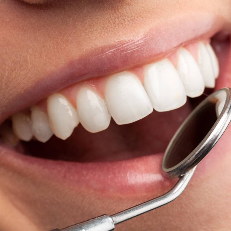 Procedura dentale eseguita dalla Dott.ssa Caporossi