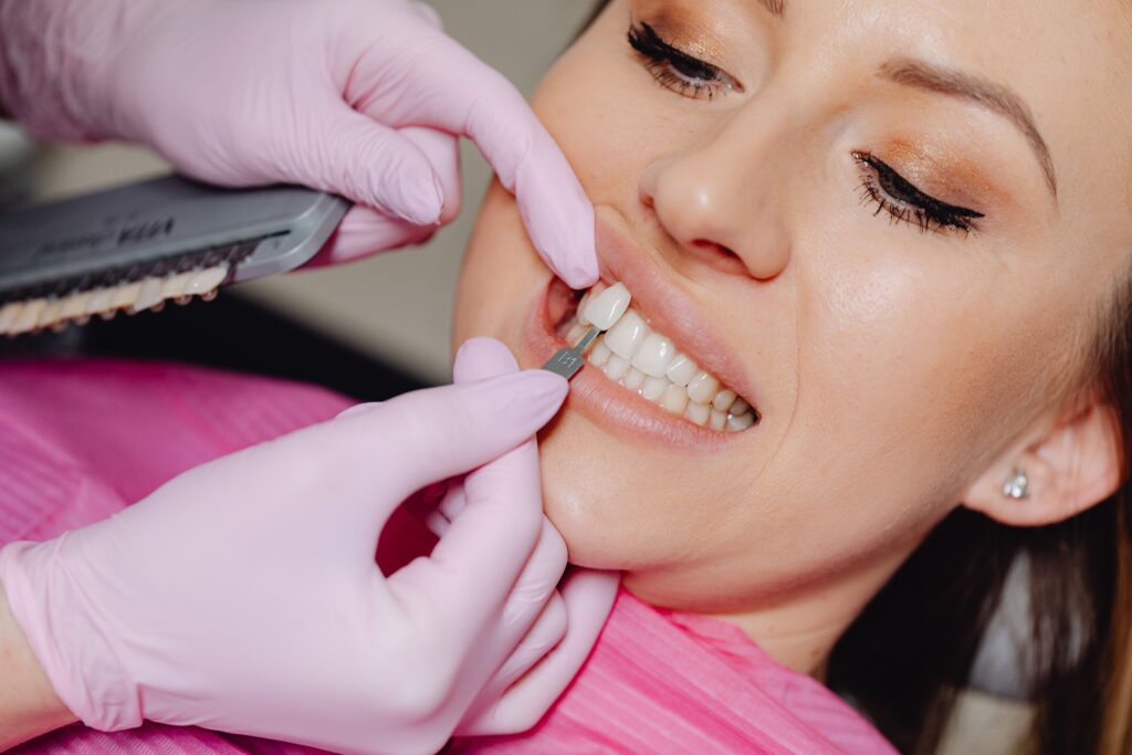 Dentista applica una faccetta di prova sul dente confrontando il colore con una mascherina campione