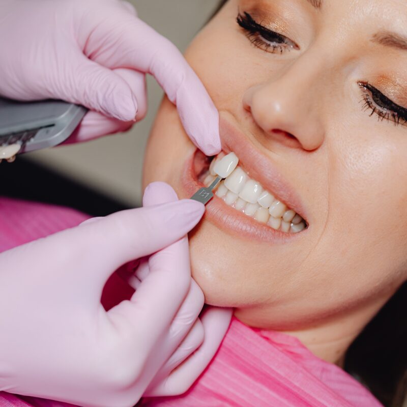 Dentista applica una faccetta di prova sul dente confrontando il colore con una mascherina campione