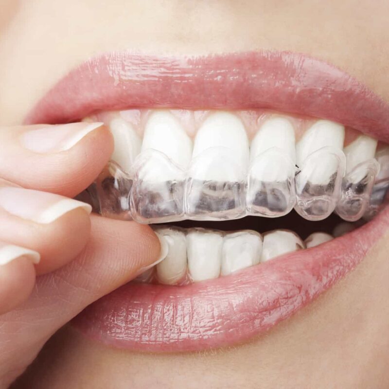 Allineatore trasparente Invisalign applicato sui denti