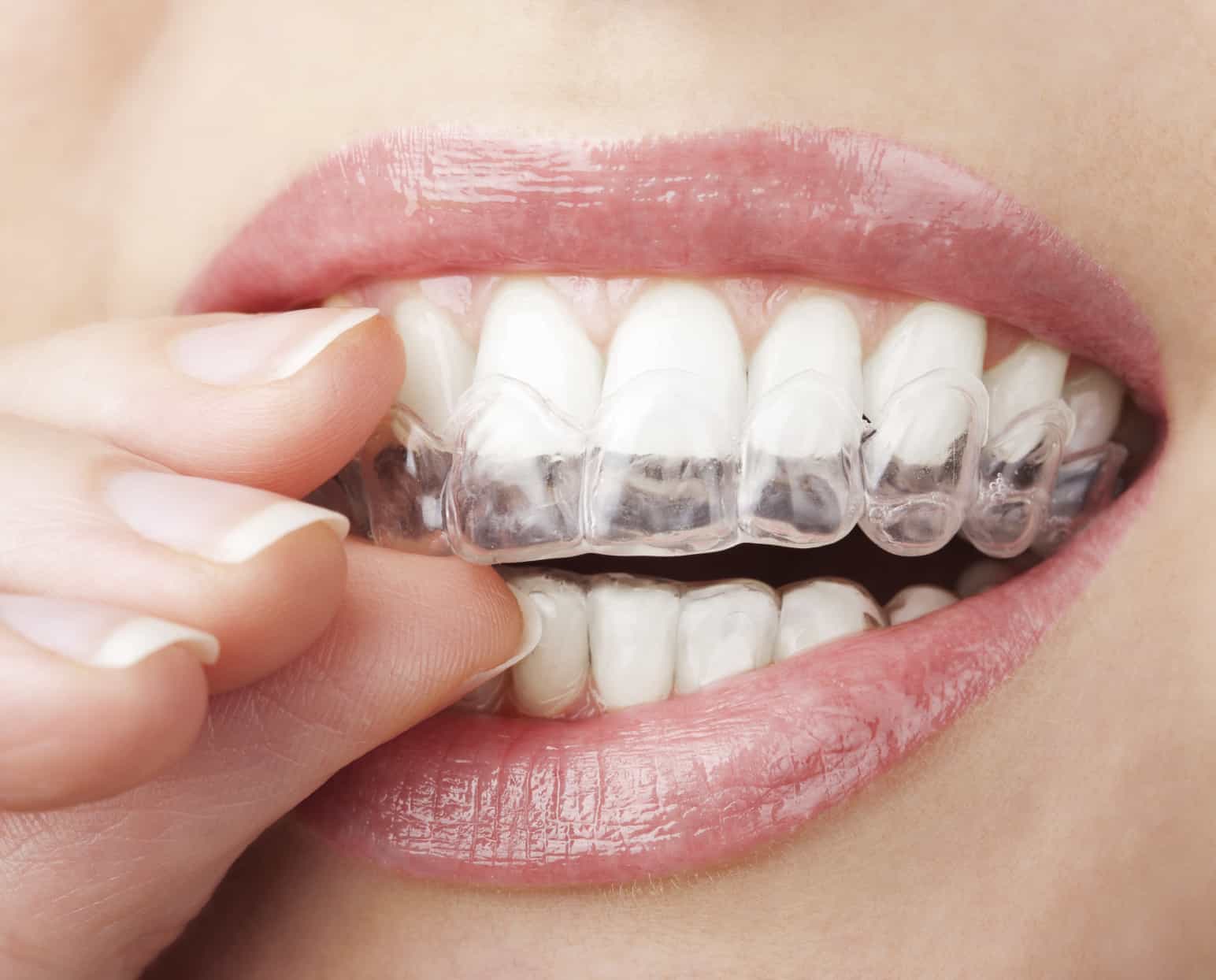 Allineatore trasparente Invisalign applicato sui denti
