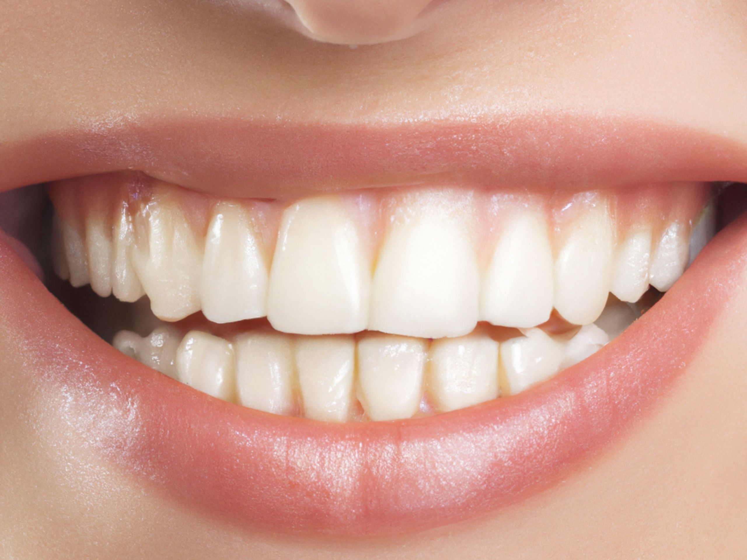 Primo piano di un sorriso con denti bianchi e luminosi