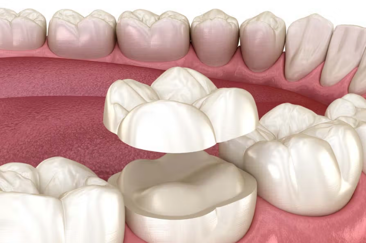 Intarsio dentale in ceramica mentre viene posizionato su un molare